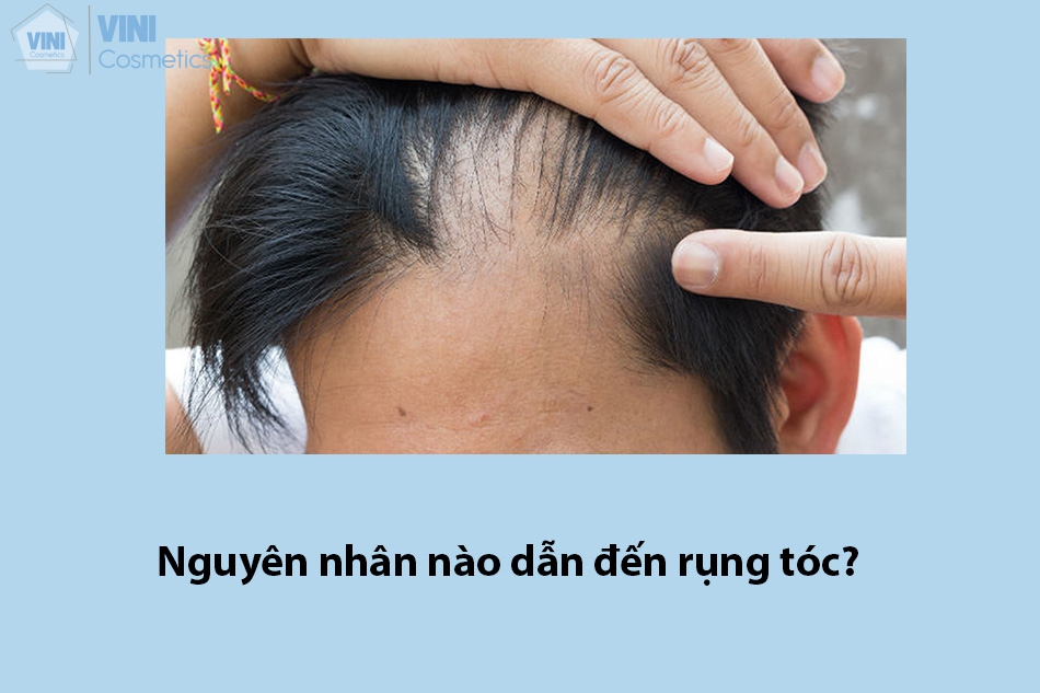Nguyên nhân nào dẫn đến rụng tóc