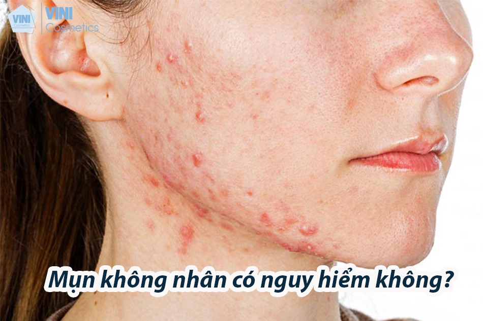 Mụn không nhân có nguy hiểm không?