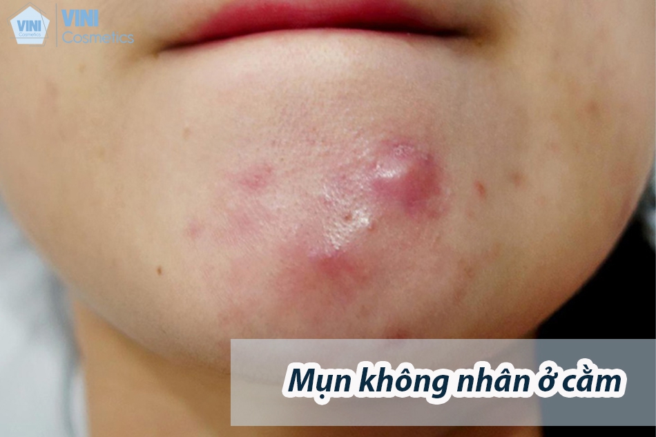 Mụn không nhân ở cằm