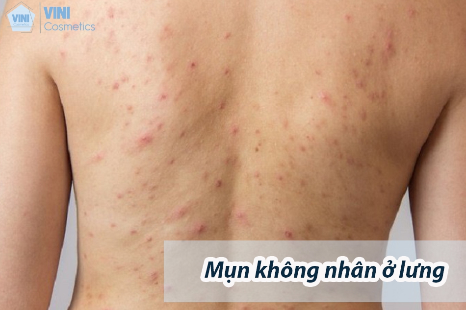Mụn không nhân ở lưng
