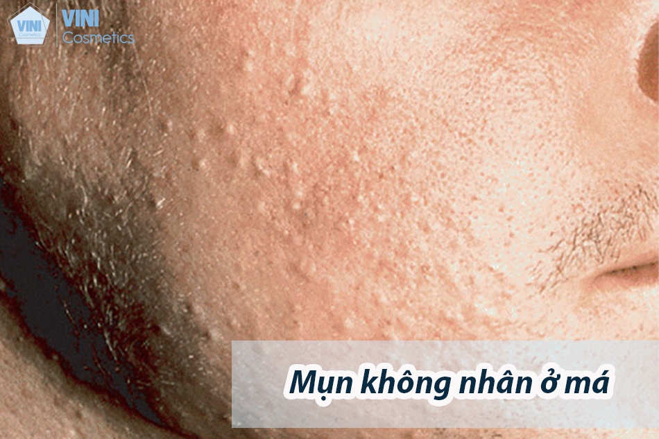 Mụn không nhân ở má