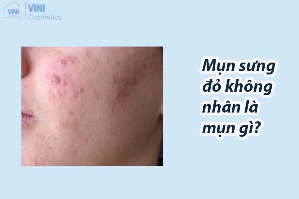 Mụn sưng đỏ không nhân là mụn gì?
